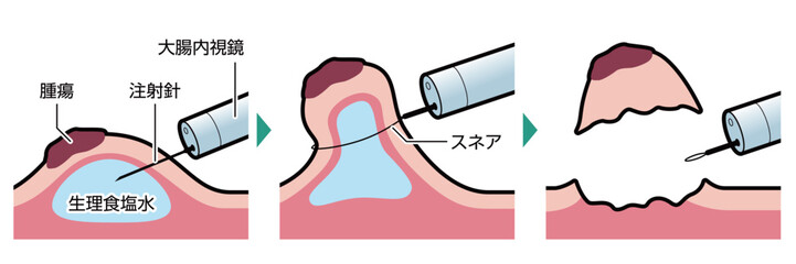 EMR（内視鏡的粘膜切除術）