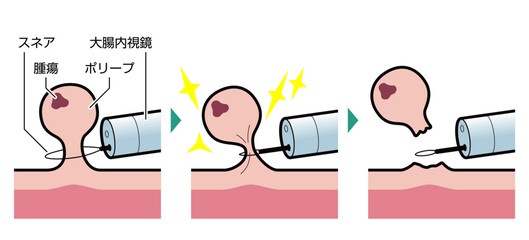 コールドポリペクトミー